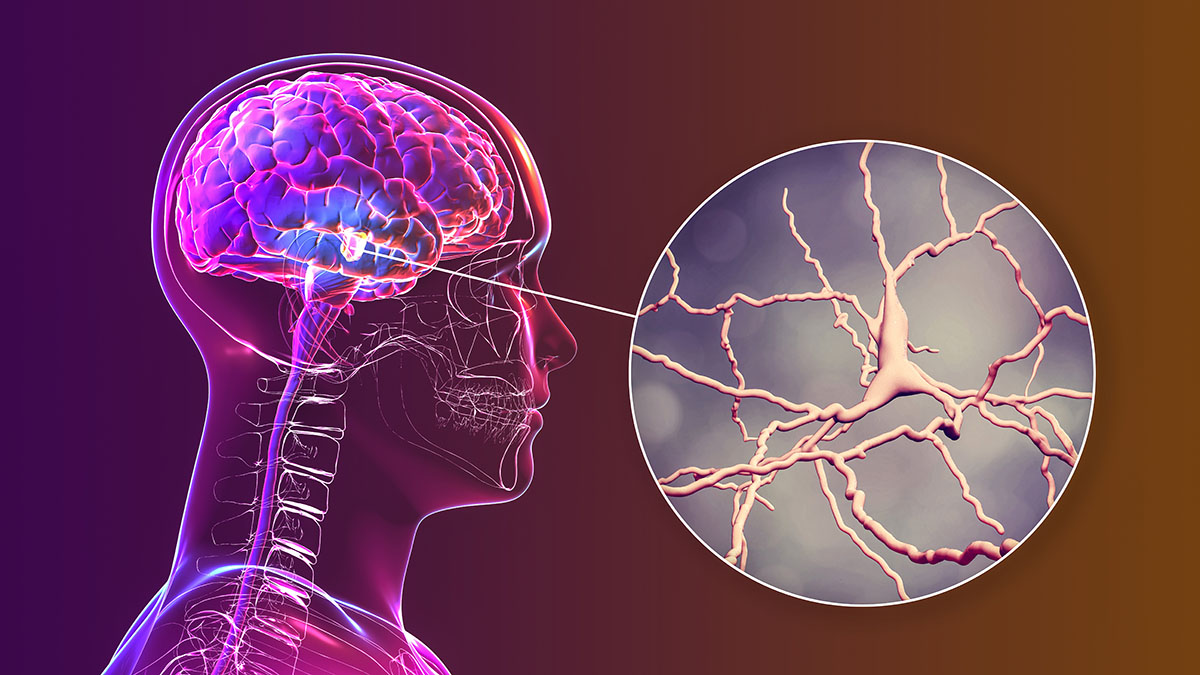 Parkinson’s Disease